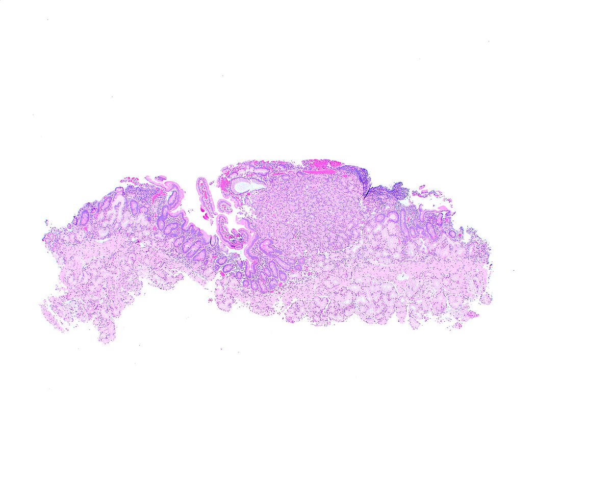 LizMontgomeryMD's tweet photo. Soon we begin interviewing for the 2028-2029 openings (3) for our Gastrointestinal Pathology fellowship at the University of Miami.  If you want to apply: 
https://t.co/i41Ii9AMzp
and send materials to 
pathology.fellowships@miami.edu
Meanwhile - duodenal gastric heterotopia! https://t.co/VRuww0U2dn