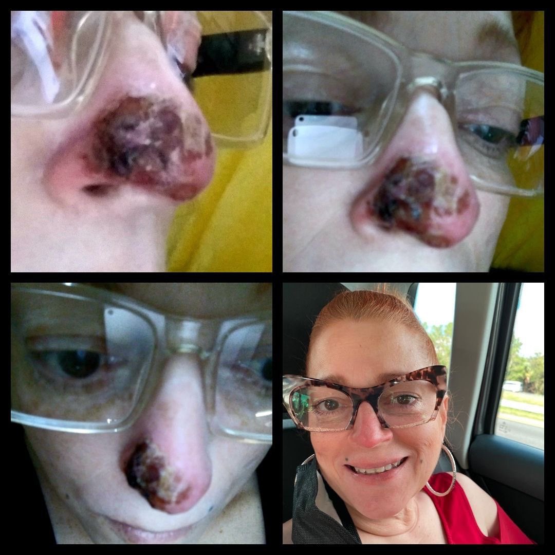 LoiCSound's tweet photo. Miracle Testimony:
Disappearance of Three Solid Tumors in the Nose After Experimental Treatment with CDS (Chlorine Dioxide)

▪️ Published on: 02.10.2021
▪️ Case: A young woman from Latin America
•She was suffering from three very large and heavy solid tumors. https://t.co/t6qOHhSosA
