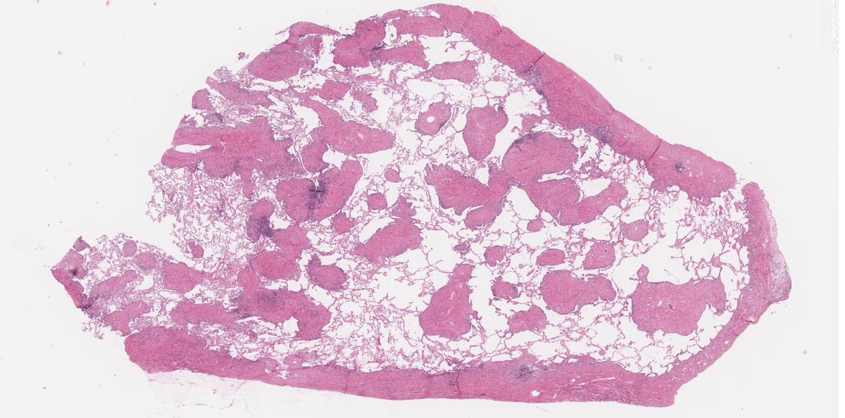 MeredithKHerman's tweet image. 50s male with dyspnea. 
Can you solve this #pathpuzzle?

Let's solve this!
#PathQuiz #PathX