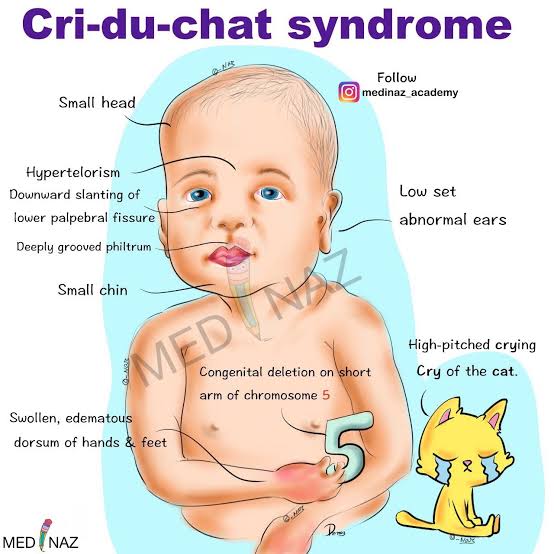 Opeyemipolymath's tweet image. Jerome legeune is a pediatrician and geneticist. He discovered cri du chat. Cri du chat is a condition in which there is deletion in the shorter arm of Chromosome 5. 
#jeromelegeune #jerome #criduchat