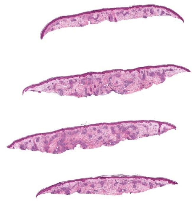 American Society of Dermatopathology tweet media
