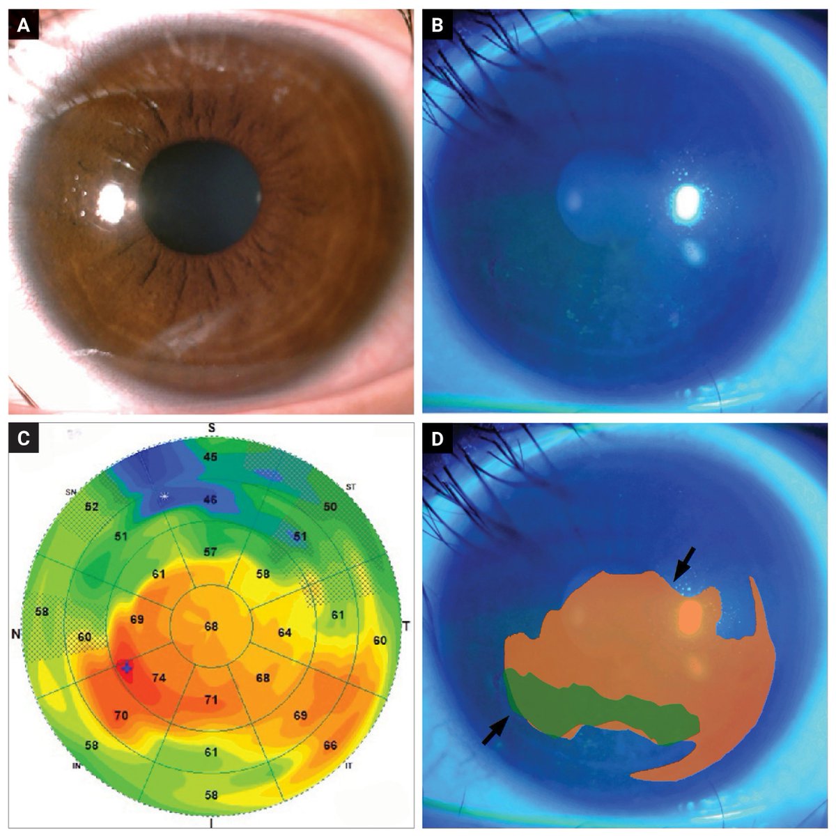 revoptom's tweet image. Corneal Epithelial Thickness Mapping Adds Precision to RCE Care

This AS-OCT technique enables more accurate treatment planning compared to fluorescein staining by identifying subclinical adhesion deficits that should also be treated.
reviewofoptometry.com/article/cornea…

#cornea #optometry