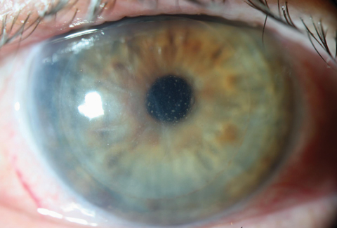 revoptom's tweet image. CME Increases Odds of Graft Rejection Post-Endothelial Keratoplasty by 11-fold

Preoperative glaucoma and younger recipient age also heightened risk in eyes that underwent DMEK or DSAEK.
reviewofoptometry.com/article/cornea…

#cornea #optometry #eyecare