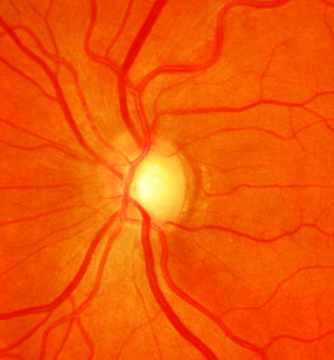 revoptom's tweet image. HRT in Older Women may Raise Glaucoma Risk

A survey of more than 6,000 patients over age 50 confirmed the association for all hormone types—estrogen, progesterone and combinations—despite considering connected health factors.
reviewofoptometry.com/article/hrt-in…

#glaucoma #optometry