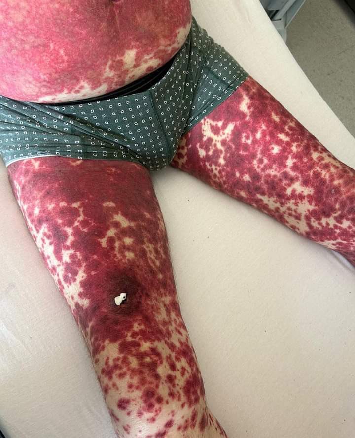 A 12yr old ♂️ having red - purplish rash over legs and abdomen accompanied by joints pain &amp; nausea.

Diagnosis ❓

A) Urticaria 
B) Henoch Schonlein purpura 
C) Multiple Myeloma 
D) ITP