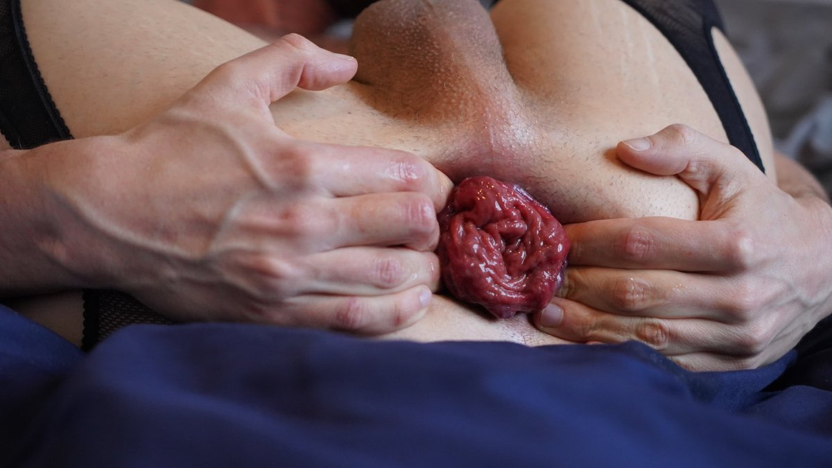 ProlapseFR's tweet photo. #prolapse #rosebud https://t.co/1SIgOIhVlC