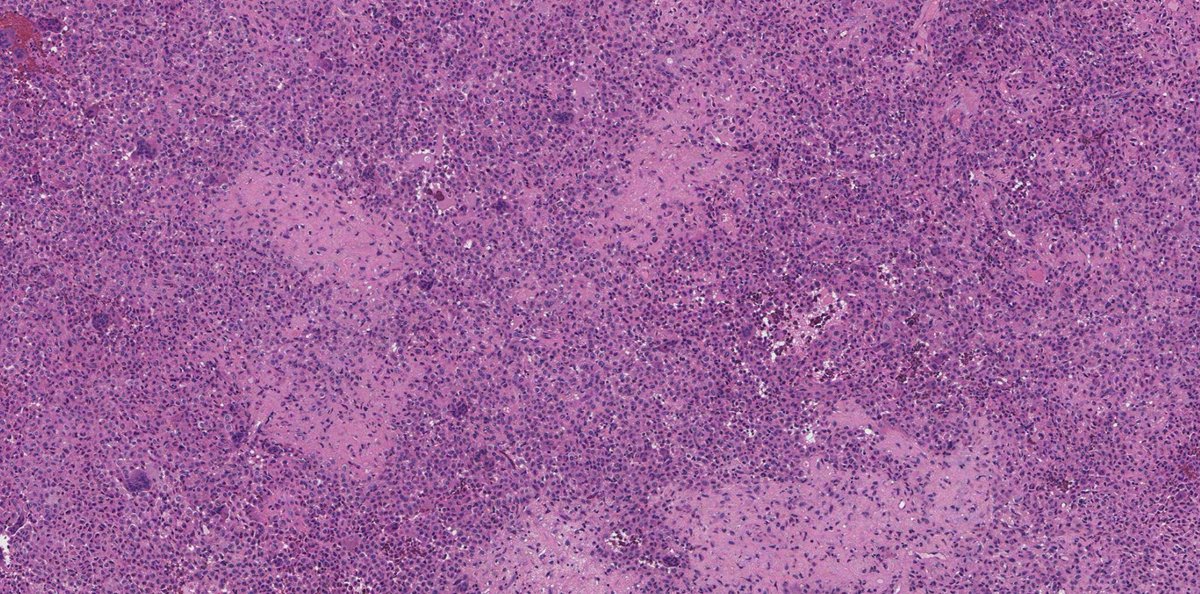 MeredithKHerman's tweet image. 30s female with knee pain. Can you make the diagnosis?

3 hints:
- Giant cells
- Chicken-wire calcifications
- K36M mutations

#PathX #pathquiz