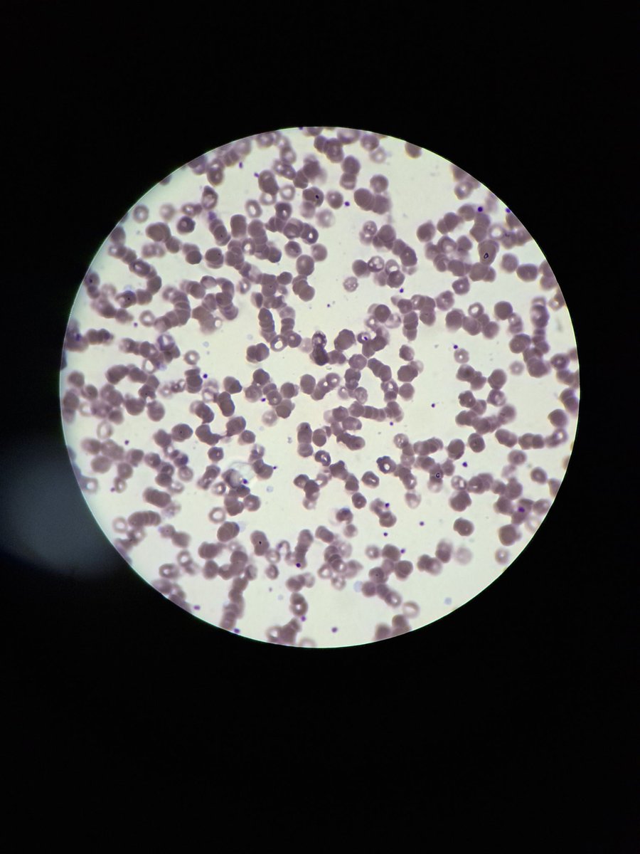 Vai tomando minhas hemacias furadas pq provavelmente to com anemia KKKKKKK