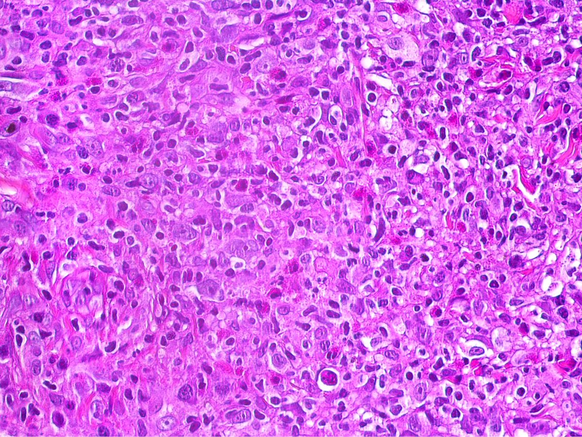 felipepfonseca's tweet image. Histiocytic sarcoma affecting the oral cavity (CD163/Lysozyme)! Discover more in our @SpringerNature book Lymphoproliferative and granulomatous disorders of the oral cavity

link.springer.com/book/978303198… 

#Pathology #OralPathology #OralMedicine #lymphoma #PathTwitter #hemepath