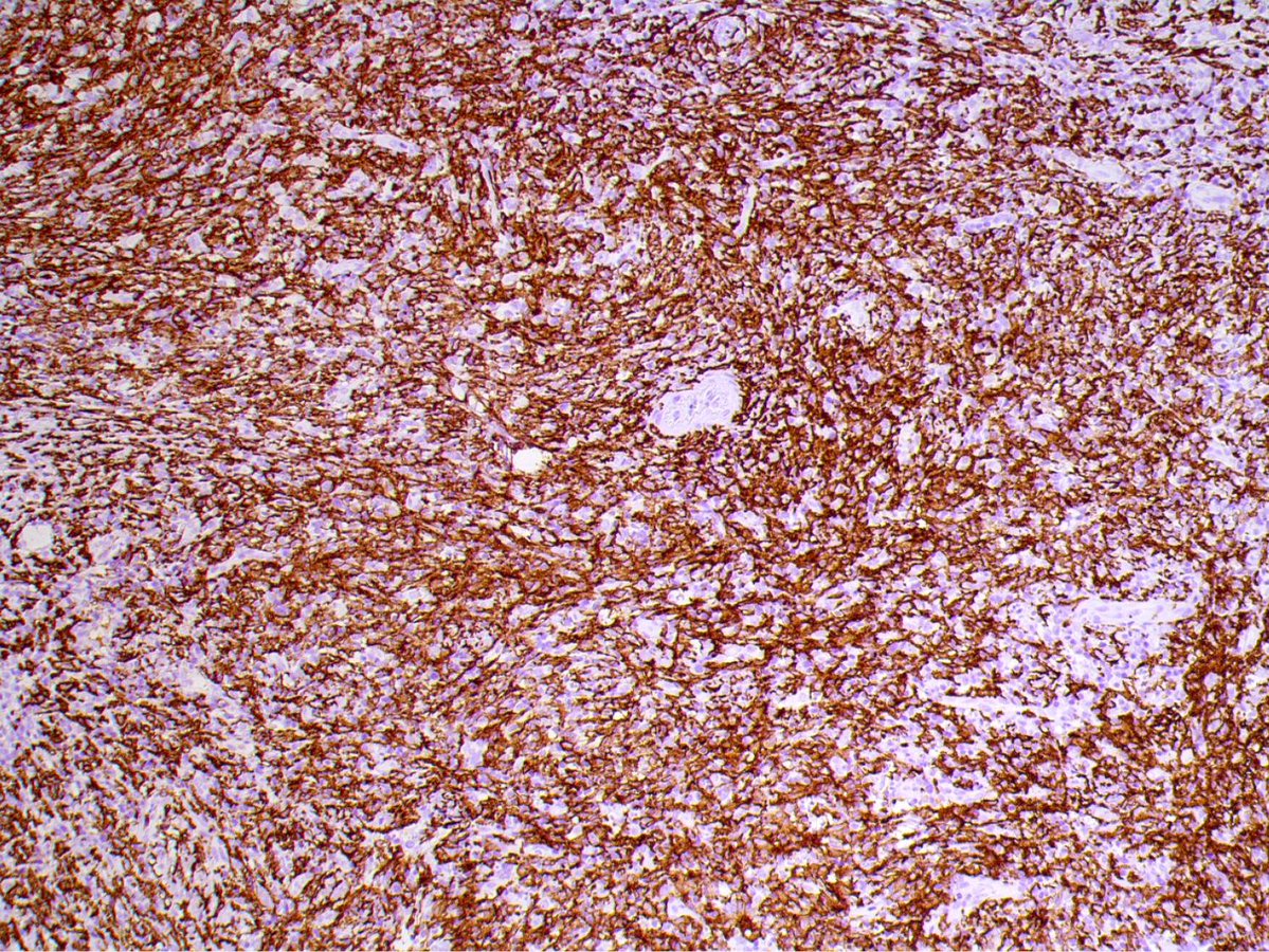 felipepfonseca's tweet image. Histiocytic sarcoma affecting the oral cavity (CD163/Lysozyme)! Discover more in our @SpringerNature book Lymphoproliferative and granulomatous disorders of the oral cavity

link.springer.com/book/978303198… 

#Pathology #OralPathology #OralMedicine #lymphoma #PathTwitter #hemepath