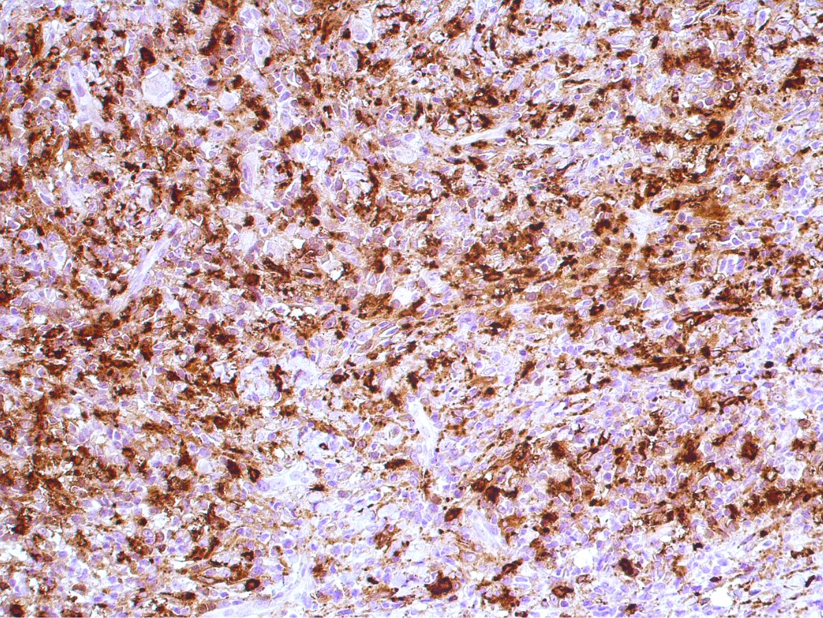 felipepfonseca's tweet image. Histiocytic sarcoma affecting the oral cavity (CD163/Lysozyme)! Discover more in our @SpringerNature book Lymphoproliferative and granulomatous disorders of the oral cavity

link.springer.com/book/978303198… 

#Pathology #OralPathology #OralMedicine #lymphoma #PathTwitter #hemepath