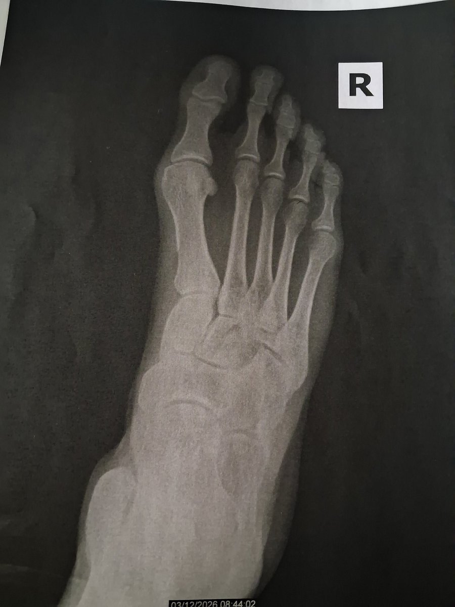 6 days looking better so far, pain isn't as bad, though really ...