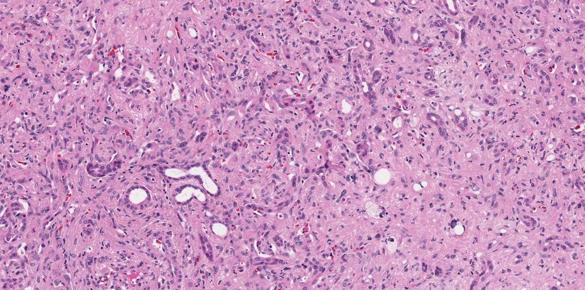 MeredithKHerman's tweet photo. Is it #PathArt or #TooCloseToDiagnose?
Clues:
🧐Bland stellate to epithelioid cells
🧐"Blister" vacuolated cells
🧐WWTR1-CAMTA1 fusion
🧐Liver
#GIPath @Pathoutlines @UMichPath https://t.co/jNAr2dgyaA