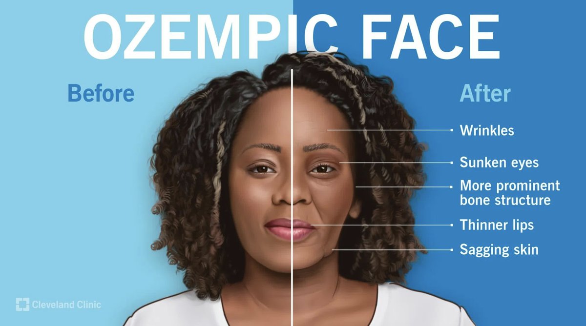 #Ozempicface: causas, por qué ocurre y si se puede prevenir bit.ly/3Qe0zJs