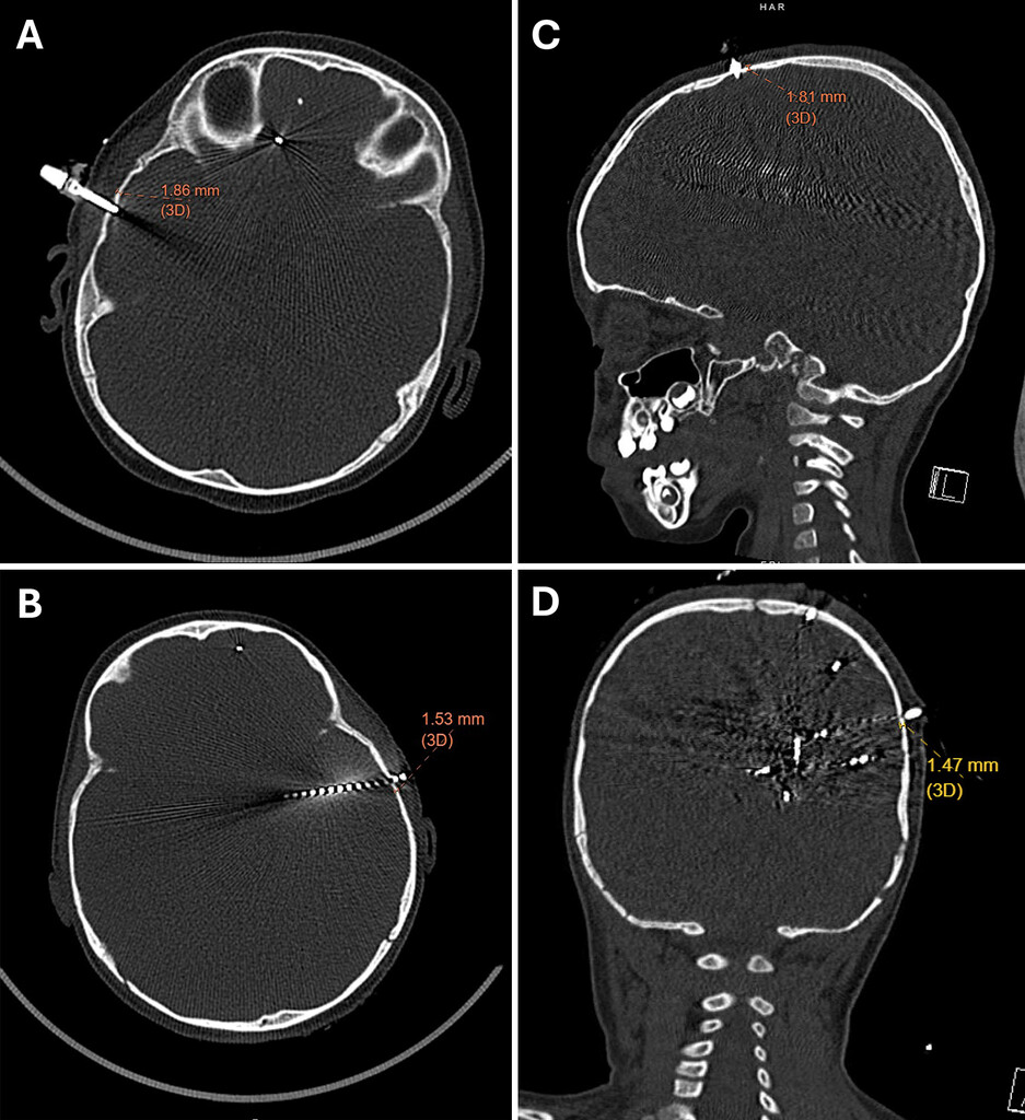 TheJNS's tweet image. #OnlineFirst: Safety, feasibility, and technique of stereo-electroencephalography in children younger than 3 years.

thejns.org/pediatrics/vie…