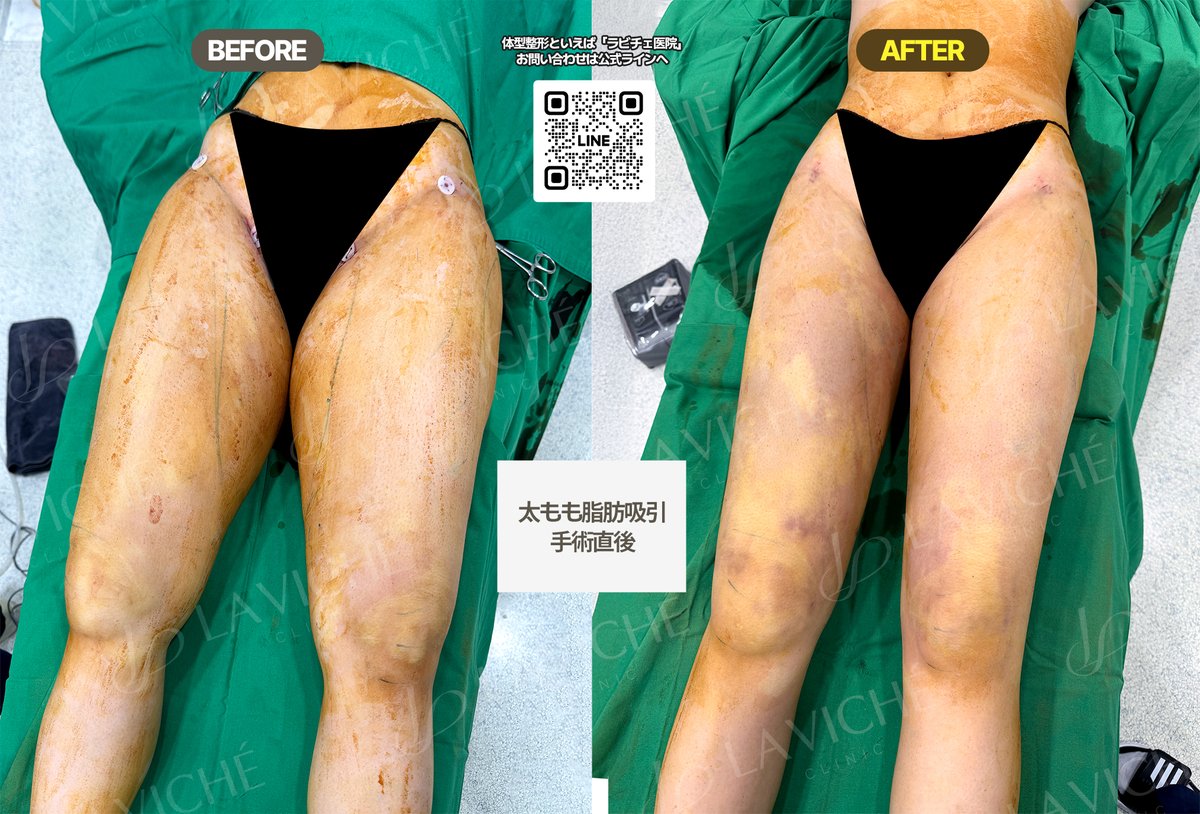 ラビチェ医院【脂肪吸引・脂肪吸入・脂肪移植・豊胸・脂肪豊胸・二重顎・二の腕・腹部・太もも・全身】 tweet media