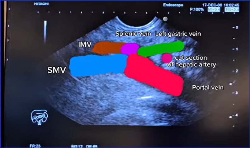 kanthMD's tweet photo. Rule of 5 Vein and 1 Artery- Examination of the Portal System from the Stomach - by Prof.Hussein Okasha #gitwitter #medtwitter #EUS https://t.co/2ZJNlfrfa9 @asianeus @GIscope_updates @EUSandEndoscopy @droktaybulur @EndoscopyNow @NeethiDasu @PrabinSharmaMD https://t.co/aCn9oEJJof