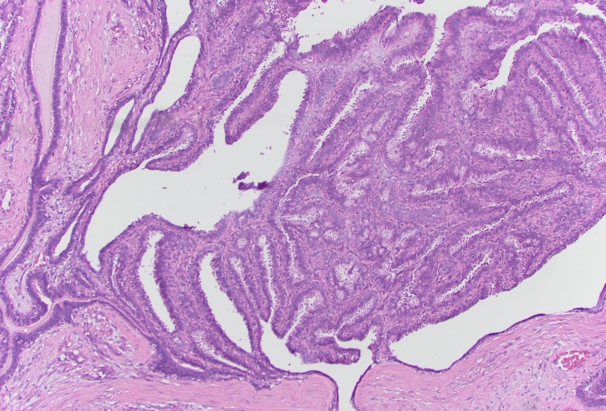CU_pathology's tweet photo. π¬ Case of the Week π¬
Can you diagnose this vulvar lesion? https://t.co/vezvgeOQa1