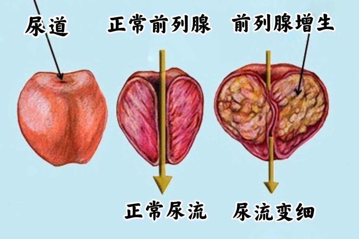 anni52308's tweet photo. 一、前列腺增生的主要病因

1年龄因素：前列腺增生发生率随年龄增长显著升高，50岁以上男性中约50%存在前列腺增生80岁以上可达90%。 
2激素雄激素（睾酮）及其代谢产物双氢睾酮（DHT的持续刺激是核心诱因雌激素水平失衡也可能参与其中。 
3遗传有家族病史的男性发病风险较普通人高2-3倍 #深圳抓龙筋 https://t.co/I7G3Twm0SZ