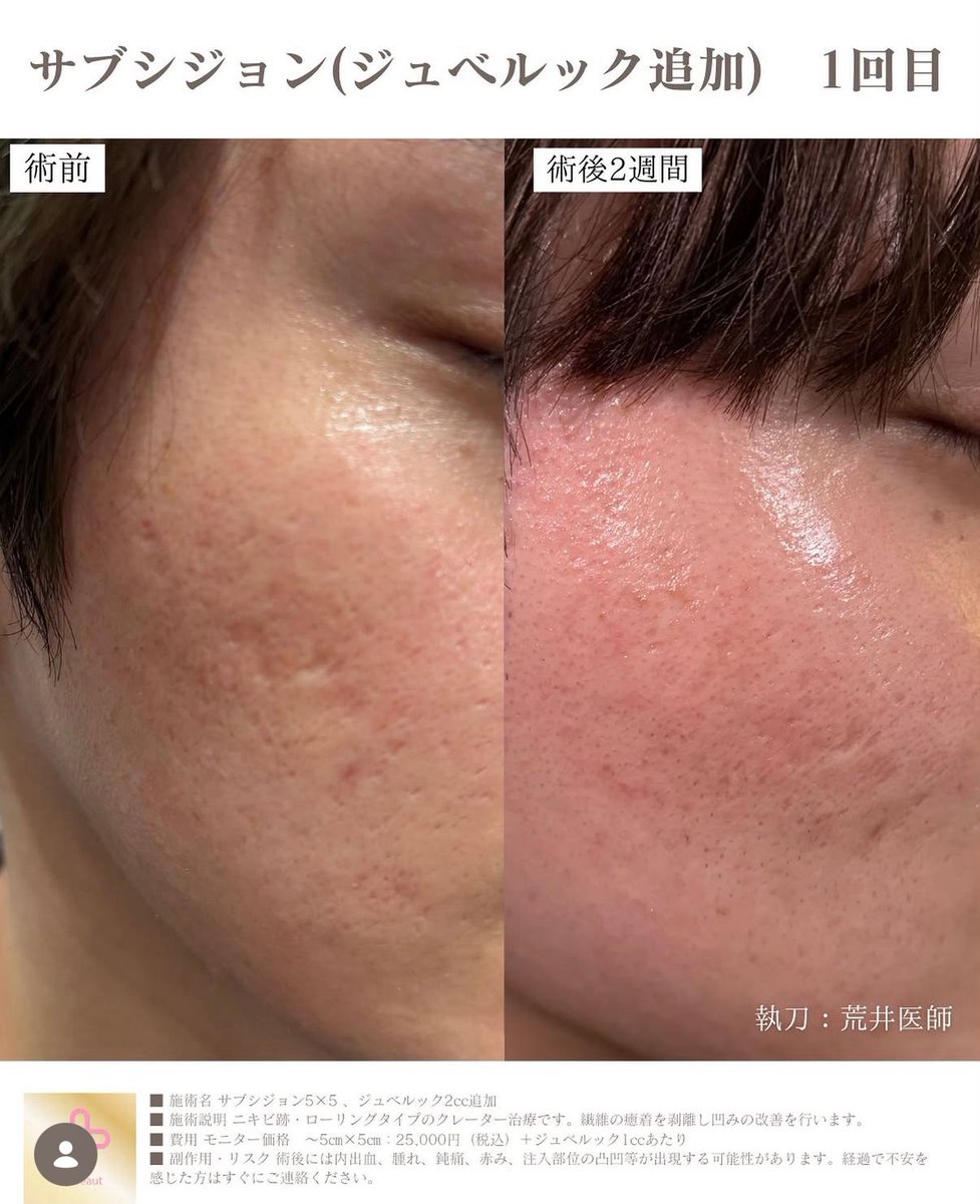 UBクリニック錦糸町院長👩‍⚕️荒井香織@目元整形、クマ取り、ベイザー脂肪吸引の美容外科医 tweet media