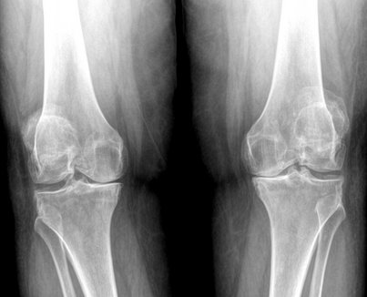 오늘 정형외과 학회에서 들은 전문가들의 의견
: 무릎 관절염 건강보조식품을 선뜻 권하지 않는 이유

무릎 관절염은 플라시보 효과가 굉장히 크게 나타나는 질환입니다.

어떤 보고에서는 밀가루로 만든 가짜약만 먹어도 50% 이상에서 1년간 효과가 있었다고 할 정도로요.

이런 점을 생각하면
