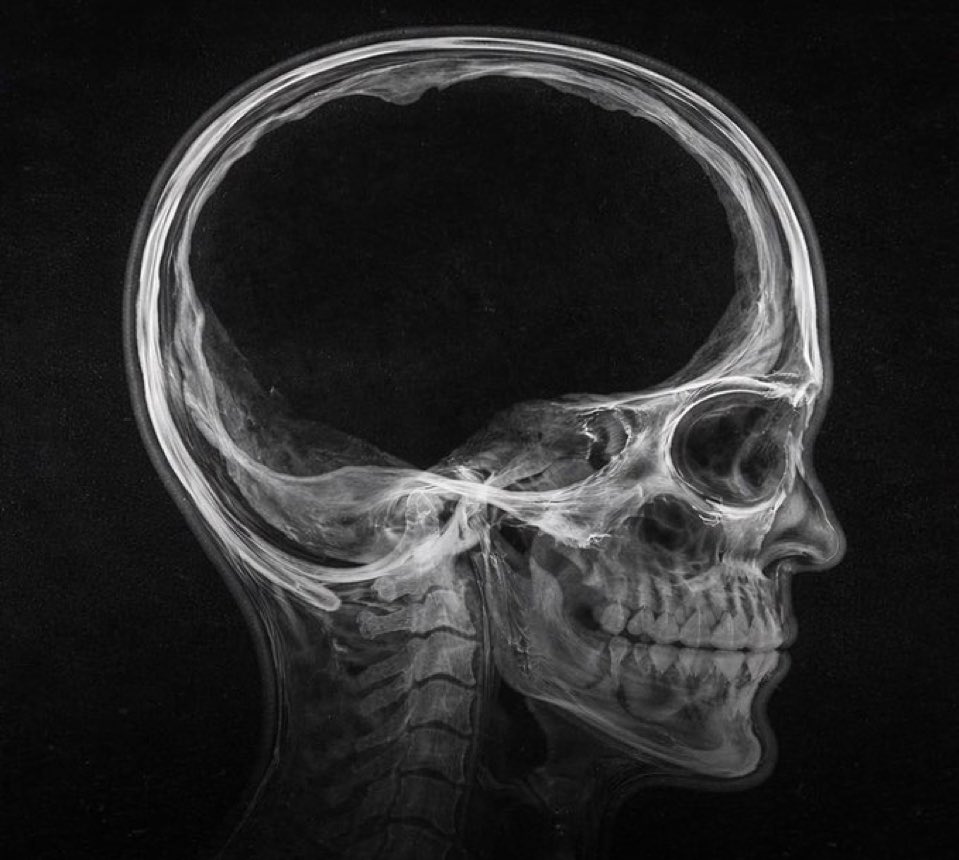 A man was discovered with almost 90% of his brain mass missing, while leading an almost normal life as a mutual fund manager in india