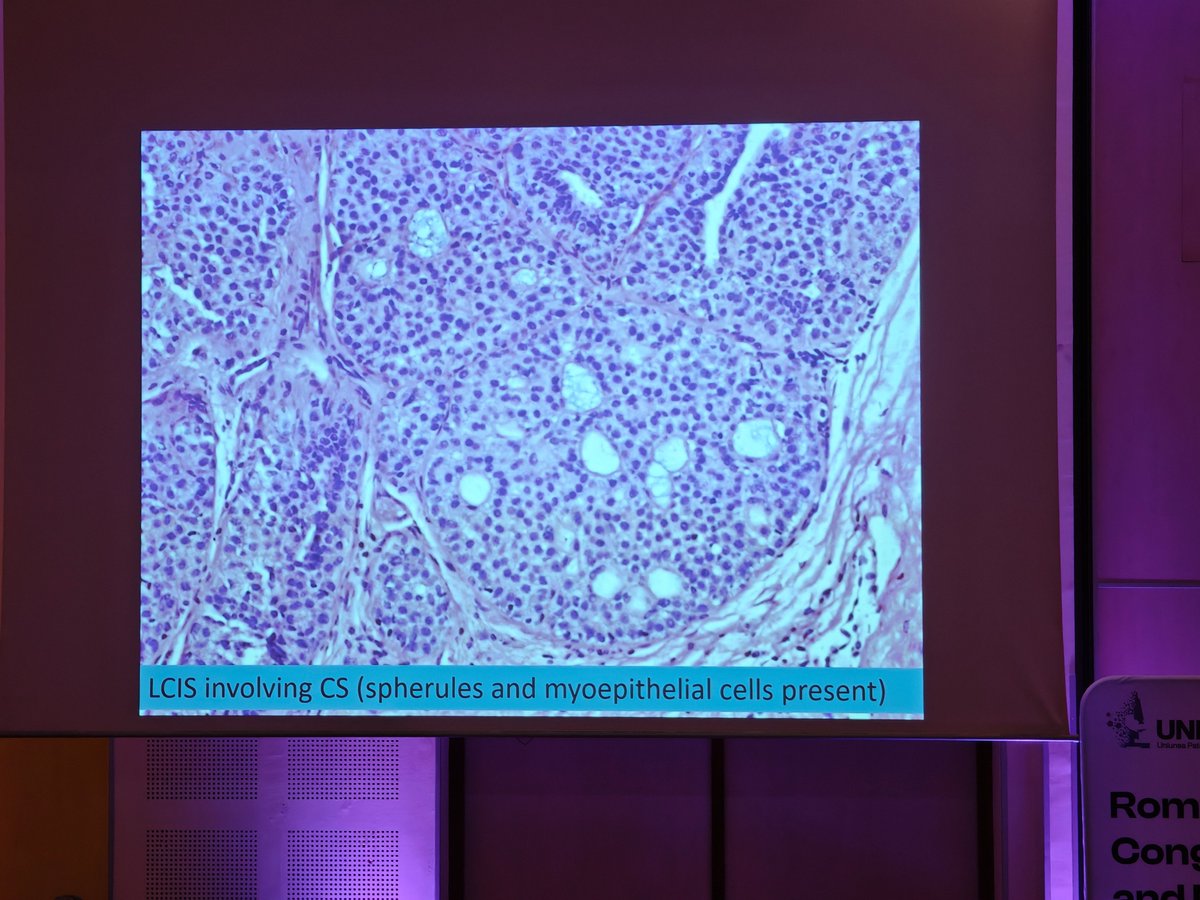 MirunaPopescu13's tweet photo. Dr. Nour Seige presenting on pitfalls in #breastpath at the first edition of the Romanian National Pathology Conference in Bucharest, Romania.
🚨LCIS involving collagenous spherulosis vs. cribriform DCIS
🔬Notice the basement membrane-like material
🎨#IHCPath myoep markers+
#PathTwitter