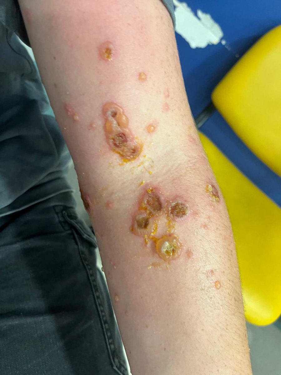 A teenage semi-professional rugby athlete presented w/ a 2-week hx of a progressive, tense bullous eruption with crusting, initially localized to the left antecubital fossa &amp; later spreading to the trunk &amp; extremities. The lesions were arranged in a linear “string of beads”