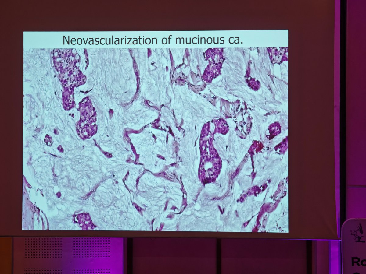 MirunaPopescu13's tweet photo. A good 🔬clue to distinguish between mucocele-like lesion (MLL) vs. mucinous carcinoma is the frequent presence of neovascularization in the latter.

Dr. Nour Seige, challenges in breast pathology, Romanian National Congress of Anatomical and Molecular Pathology, First Edition, Bucharest, Romania

#breastpath #PathTwitter