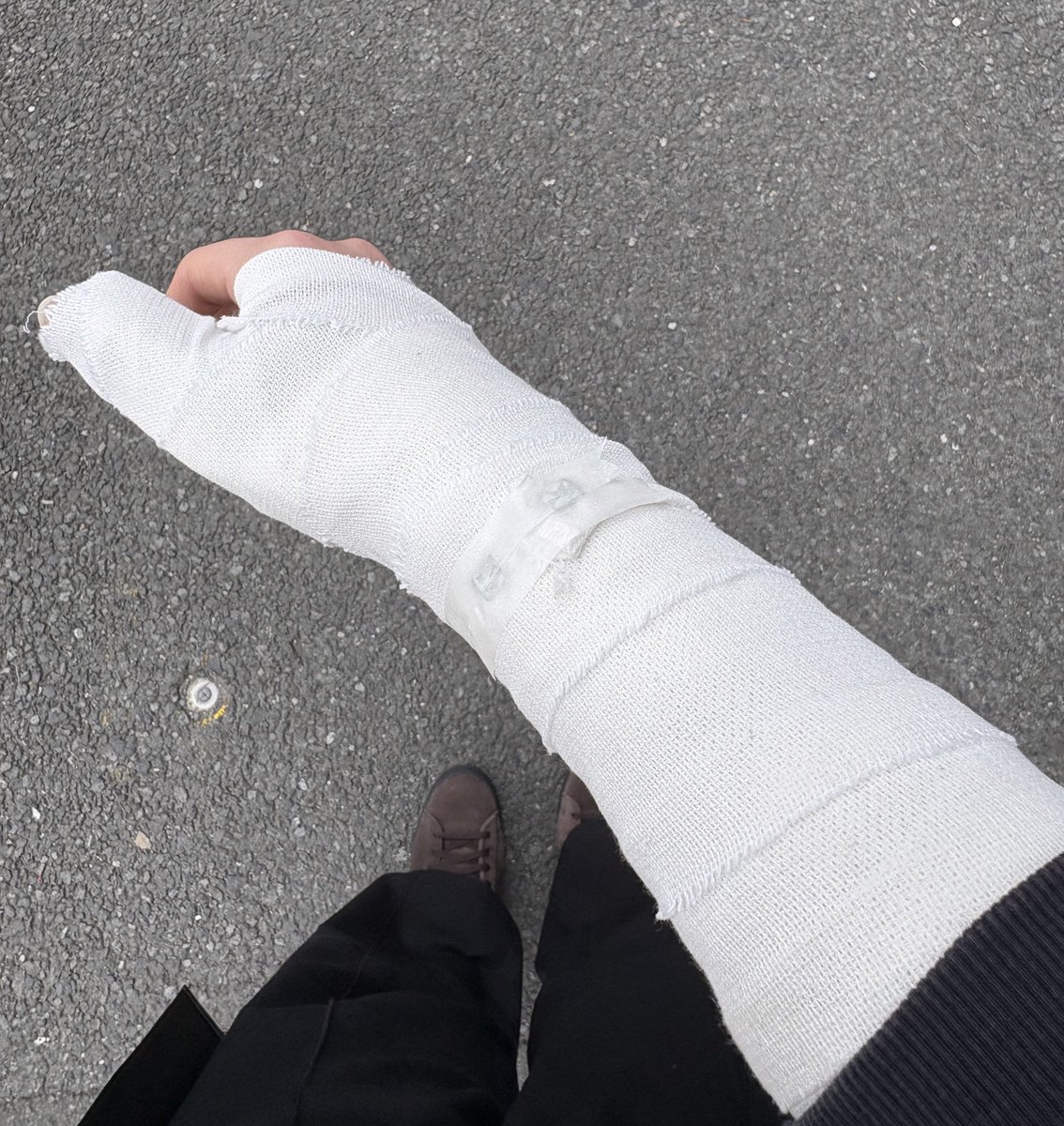 今右手がこんなことになってるので、

・5/6コスダン
・5/8CDEF

はほぼ確実に右手に何かを付けたままの可能性がでかいです🥲（普通に痛いので本気で踊れるかも不安）

キャラがつけてないもの付けての参加になるのでツイートさせてもらいました💦