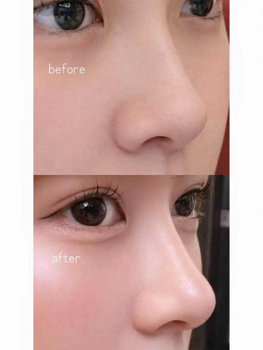 __runababy__'s tweet photo. プロテ入ってないです！私は肋軟骨でやってます🪄本当にお鼻の整形大満足してるから良かったら @girinjp 参考にしてみてください！既に私の投稿を見て伺ってくれた方がいるみたいで嬉しい😭
#マシュマロを投げ合おう
https://t.co/HcjkGjuhLk https://t.co/W6V3lL96cX