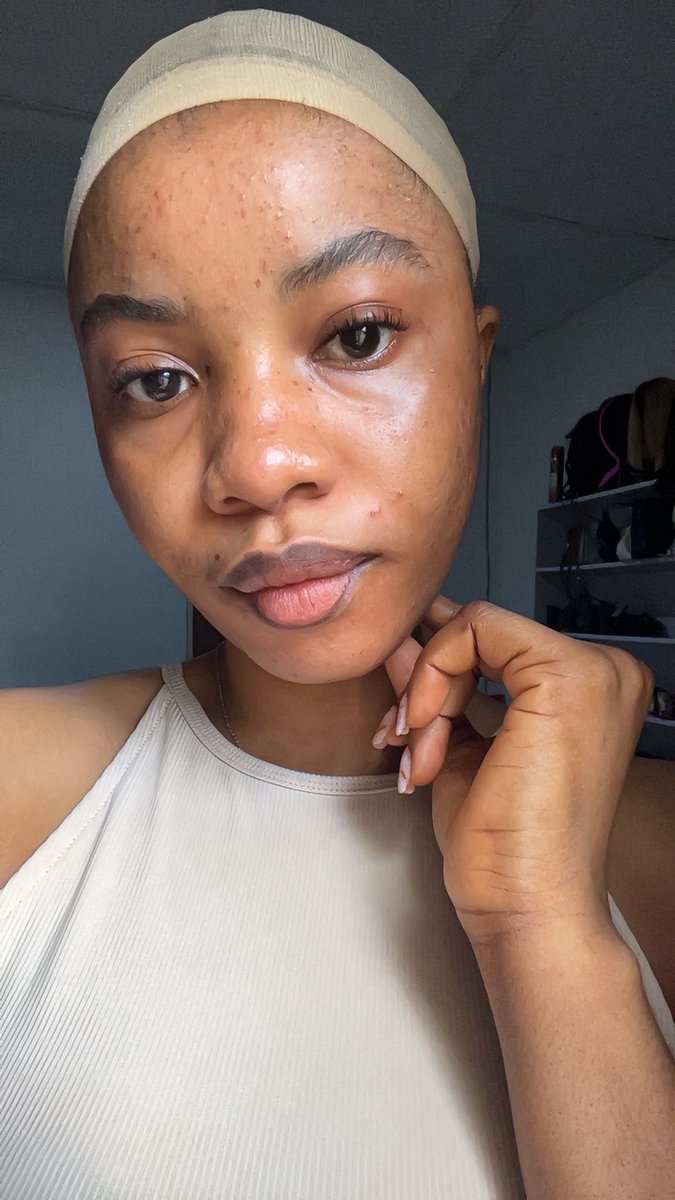 itsmira007's tweet image. be honest… would you post your skin like this? 👀
#NormalizeRealSkin #NoFilterNeeded  #AcneIsNormal #LoveYourSkin
