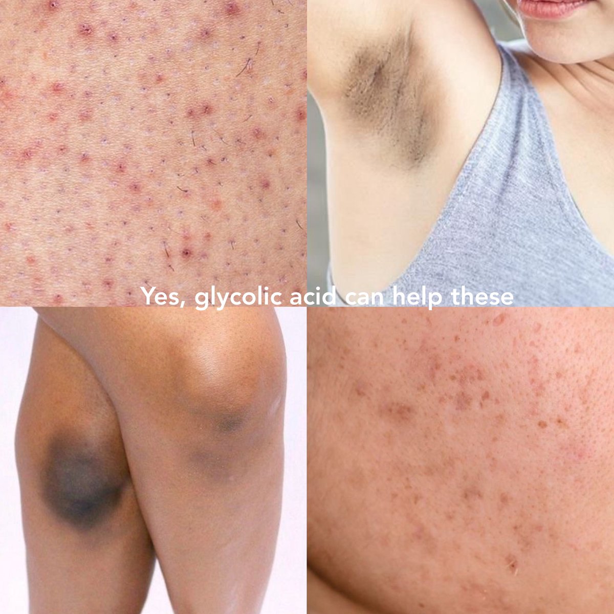 nanaspineapel's tweet photo. Ketek gelap, chicken skin, darkspot…. kuncinya cuma pake Glycolic Acid ajaaa bener2 multifungsi bgt😭✊🏻

THE PROBLEM                                      THE SOLUTION https://t.co/QZF2UhMh2p