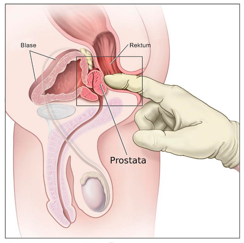 dogalyasalar's tweet photo. PROSTAT İÇİN EN İYİ ÜRÜNLER

• Uzun süre oturmamak → pelvik dolaşım
• Düzenli boşalma → prostat drenajı
• Beta-sitosterol → idrar akışı
• Çinko → prostat dokusu desteği
• Selenyum → antioksidan koruma
• Likopen → oksidatif stres azalması
• Kabak çekirdeği ekstresi → idrar rahatlatma
• Pygeum africanum → gece idrarı azaltma
• Isırgan kökü → BPH desteği
• Omega-3 → inflamasyon kontrolü
• Quercetin → prostat inflamasyonu
• Kurkumin → COX-2 baskılama
• Resveratrol → hücresel koruma
• Yeşil çay (EGCG) → antioksidan etki
• Polen ekstresi → prostat konforu
• Melatonin → hücresel koruma
• Düzenli egzersiz → dolaşım artışı
• Bel çevresi kontrolü → aromataz azalması
• Paketli gıda azaltımı → insülin dengesi
• Alkol kısıtı → inflamasyon düşüşü
• Saw Palmetto → DHT modülasyonu