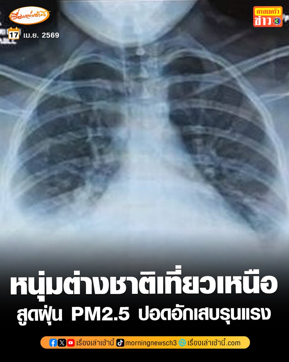แพทย์ มช.เผยเคส ผู้ป่วยชาวต่างชาติวัย 19 เที่ยวภาคเหนือ สูดฝุ่นพิษ PM2.5 ปอดอักเสบรุนแรง เกือบเอาชีวิตมาทิ้งเมืองไทย

อ่านข่าว : ch3plus.com/news/socialnew…

#เรื่องเล่าเช้านี้ #ครอบครัวข่าว3 #ข่าวโซเชียล