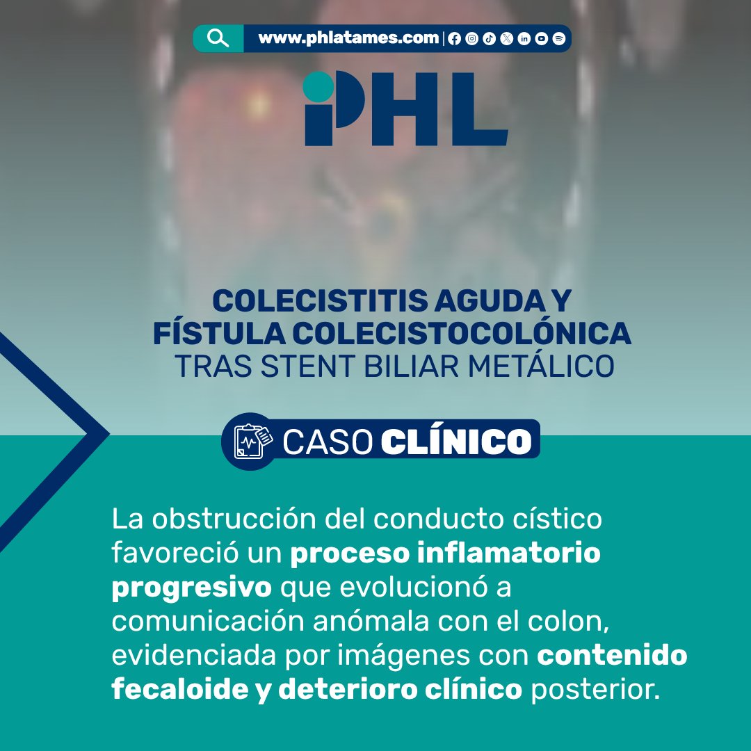 PH_Latam's tweet image. 🔬 ¡Caso Clínico! | Le contamos 📲 ow.ly/e3TC50YKJi8 
¿En qué momento sospecharías una complicación así?

Paciente con cáncer pancreático tratado con stent biliar desarrolló colecistitis aguda y una fístula colecistocolónica, una evolución grave.

#PHL #Gastroenterología