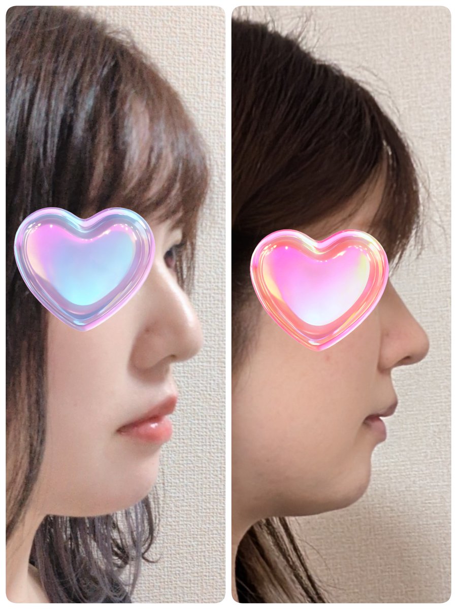 gabriel_doll_'s tweet photo. 《DT 6ヶ月》
あっという間に半年！！！ハーフ？って言われるくらい高かった鼻も落ち着いてきて、前までちょっと大きめだった鼻先も（それはそれで愛おしかった）すっきりしてきた🫶🏻💞正面から見るとなんだかんだまだ腫れてるのかな？て感じするけど後戻り含め大満足❣️❣️
↓びふぉ＆今日 https://t.co/oNVYhkU7QB