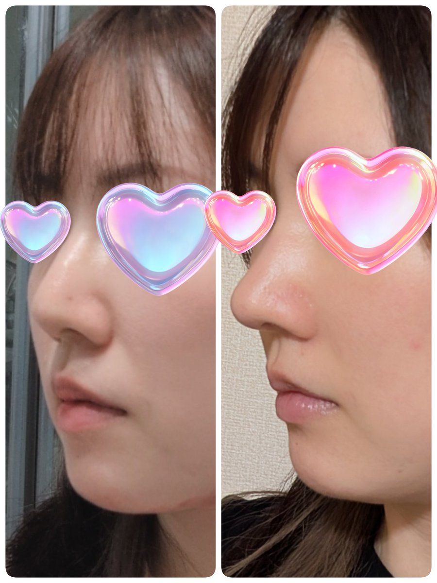 gabriel_doll_'s tweet photo. 《DT 6ヶ月》
あっという間に半年！！！ハーフ？って言われるくらい高かった鼻も落ち着いてきて、前までちょっと大きめだった鼻先も（それはそれで愛おしかった）すっきりしてきた🫶🏻💞正面から見るとなんだかんだまだ腫れてるのかな？て感じするけど後戻り含め大満足❣️❣️
↓びふぉ＆今日 https://t.co/oNVYhkU7QB