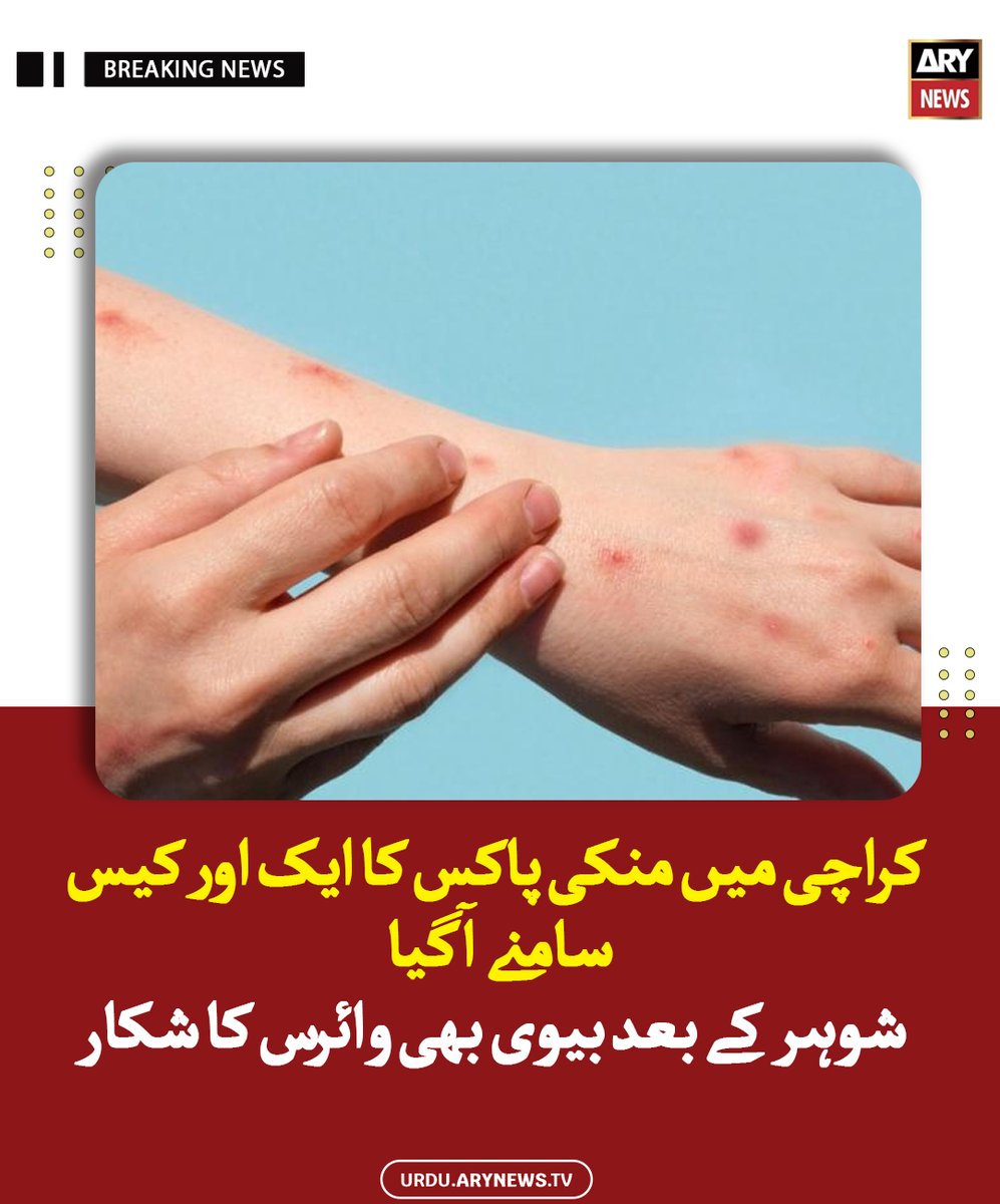 arynewsud's tweet image. کراچی میں منکی پاکس کا ایک اور کیس سامنے آگیا، شوہر کے بعد بیوی بھی وائرس کا شکار

مزید پڑھیں : urdu.arynews.tv/monkeypox-anot…

#ARYNewsUrdu #Karachi #MonkeyPox