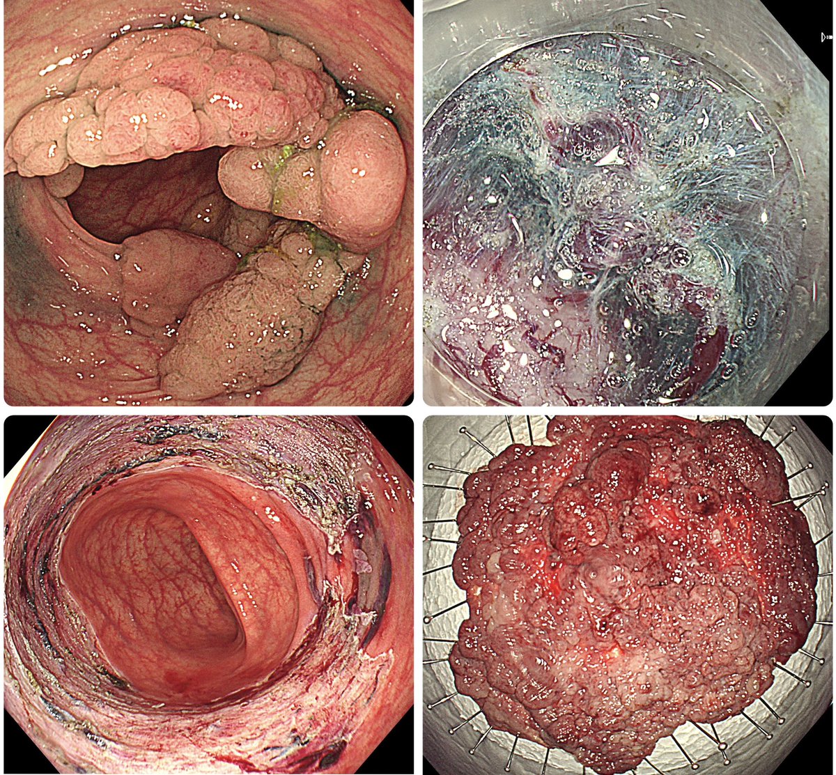 ben_sukit's tweet image. ESD of a 10.5-cm laterally spreading tumor (LST) at the distal transverse colon near the splenic flexure. The scope manipulation was struggling. I utilized traction clips to facilitate the dissection. and got it done after 284 minutes.
#ESD #EndoscopicSubmucosalDissection