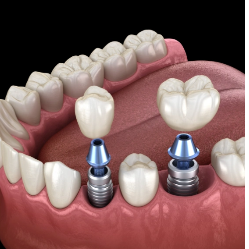 thrivedentistry's tweet photo. Missing teeth? Dental implants offer a strong, natural-looking solution that lasts for years.
Restore your smile, confidence, and bite with a permanent fix that feels just like real teeth. Visit us: https://t.co/m0P91JAiEl https://t.co/rQ4vM3kEnO