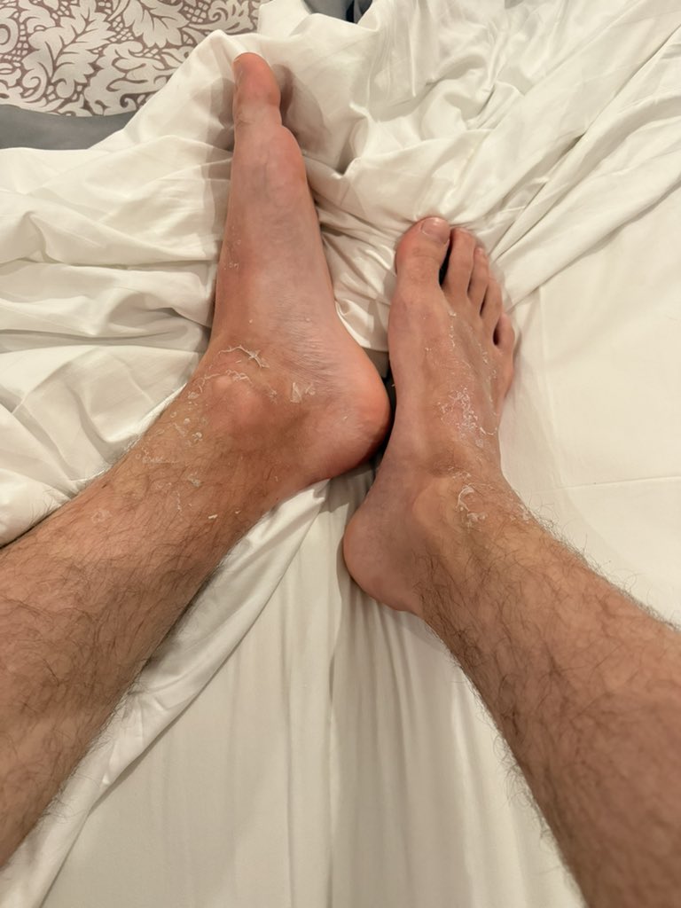 PlayerrEzio's tweet photo. Sunburn got bad… now it’s peeling.
Be honest… who would actually want to see me peel it off? https://t.co/IohzrpeOf6