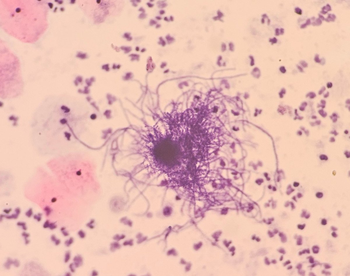 AnupamaArya12's tweet image. 40/F Pap smear #cytopath #pathtwitter #pathresidents #pap