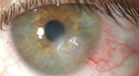 KRKISHOREKUMAR3's tweet image. Evaporative Dry Eye cannot be cured, but can be treated
dearkish.blogspot.com/2026/04/evapor…
Dry eye, especially the evaporative type, is highly manageable but not permanently curable. The best outcomes come from a personalized treatment plan.
#common #condition #tears #evaporate #quickly