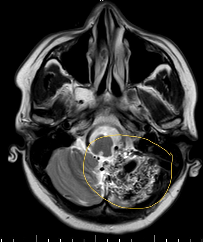 hyderabaddoctor's tweet image. (For doctors)
Describe the findings and possible diagnosis?

#neuroradiology #neurology #neurotwitter
