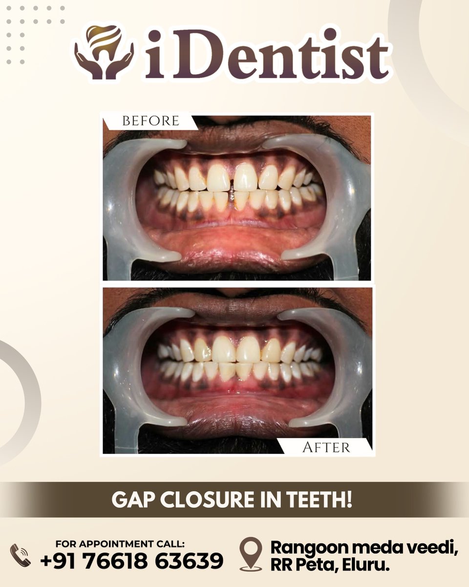 identist6240's tweet image. 😁✨ Transform Your Smile with Gap Closure Treatment! ✨😁

Say goodbye to gaps and hello to a confident, beautiful smile with iDentist 🦷💙

📞Book Your Appointment Today: +91 76618 63639

😊 iDentist – Where Your Perfect Smile Begins!

#iDentist #SmileTransformation #GapClosure