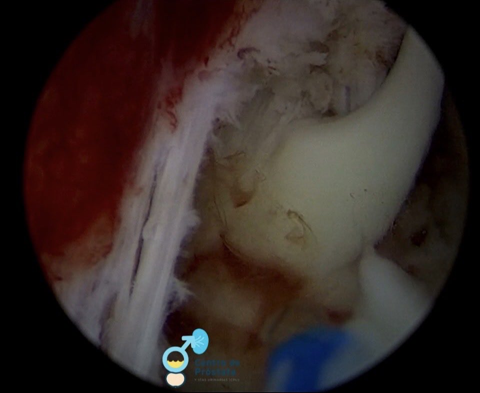 UroBruce's tweet image. Prostatic abscess drained by #HOLEP, emergency prostate surgery is also indicated and again HOLEP clearly demonstrates superiority compared to TURP-B.

#aeep #eep @migueluromexico