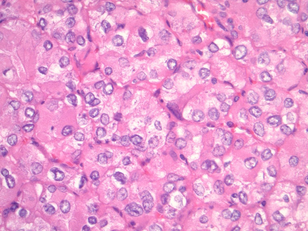 DrCycloPath's tweet image. #PathQuiz 🔬

A) Chromophobe RCC
B) Oncocytoma
C) SDH-Deficient RCC
D) Eosinophilic Solid and Cystic RCC

#Pathology #GUPath
