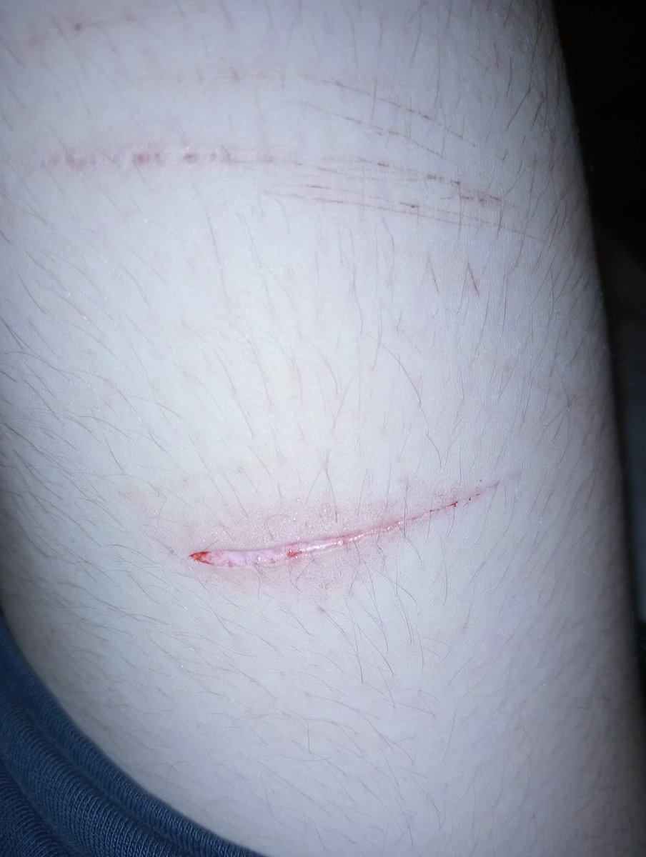 amechannshtwt's tweet image. What it looks like blood free! 

#shtwt #shedtwt #cuts #sytro #slitwt #cutspo (ALL FAKE VFX MAKEUP!!)