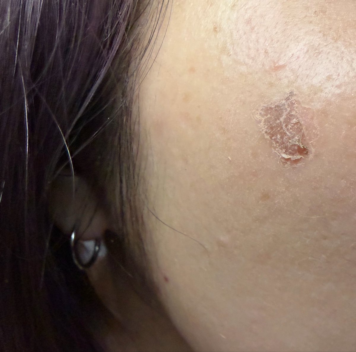 シミ取りレポ➃- シミ取りしてから約1ヶ月！ 1枚目がBeforeで2枚目が1